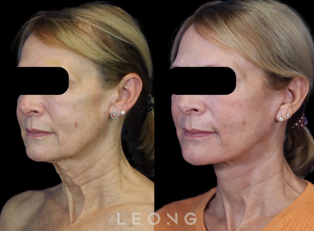 Facelift Before & After Gallery - Patient 301107 - Image 5