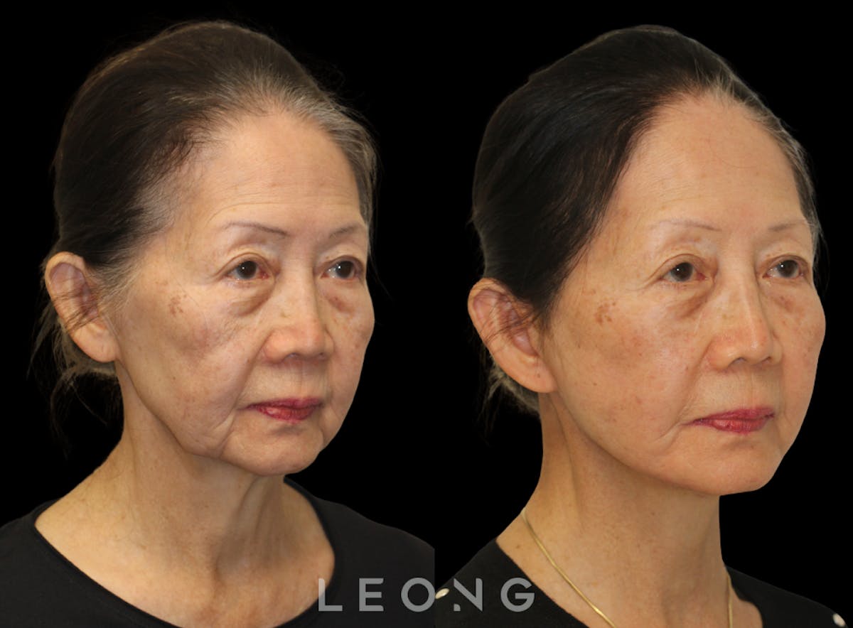 Facelift Before & After Gallery - Patient 309273 - Image 3