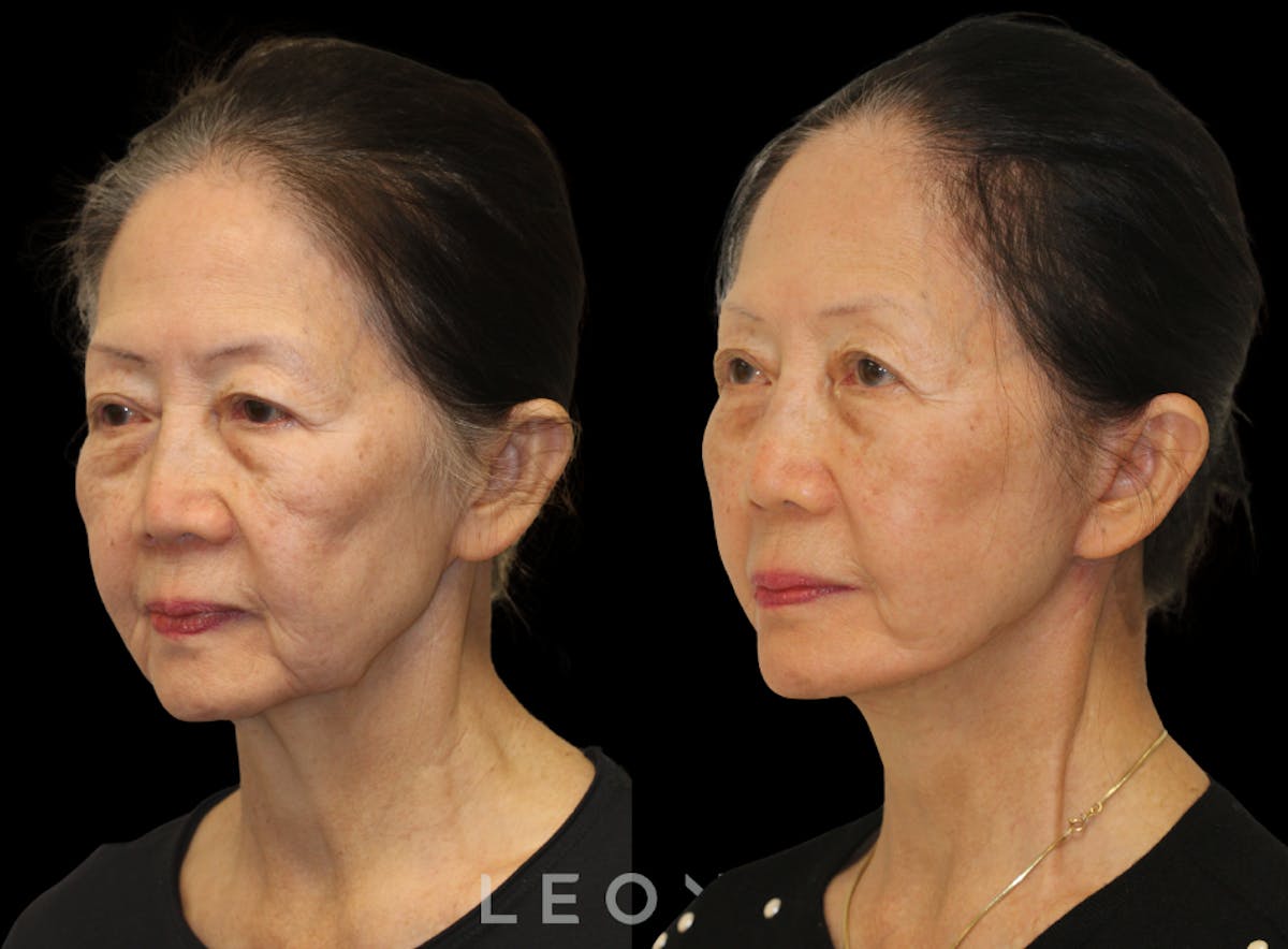 Facelift Before & After Gallery - Patient 309273 - Image 4