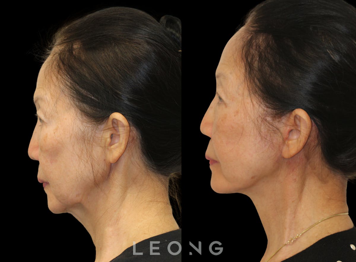 Facelift Before & After Gallery - Patient 309273 - Image 5