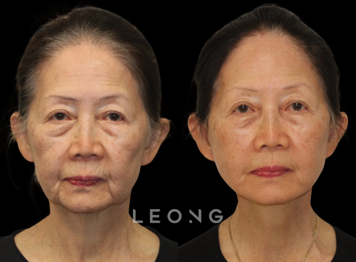 Facelift Before & After Gallery - Patient 309273 - Image 1