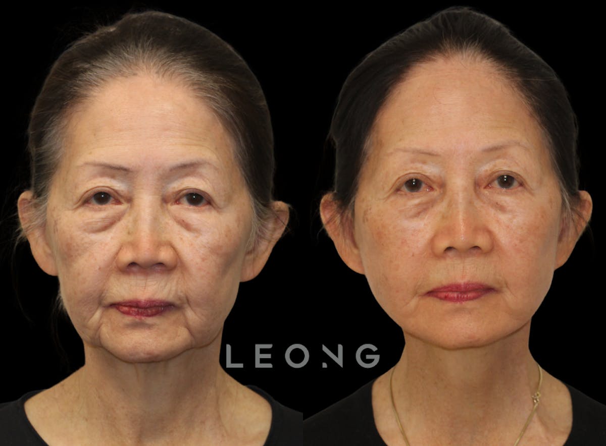 Facelift Before & After Gallery - Patient 309273 - Image 2