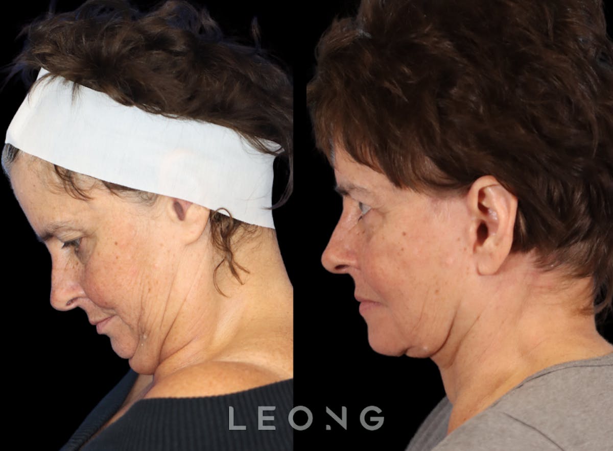 Facelift Before & After Gallery - Patient 231963 - Image 2