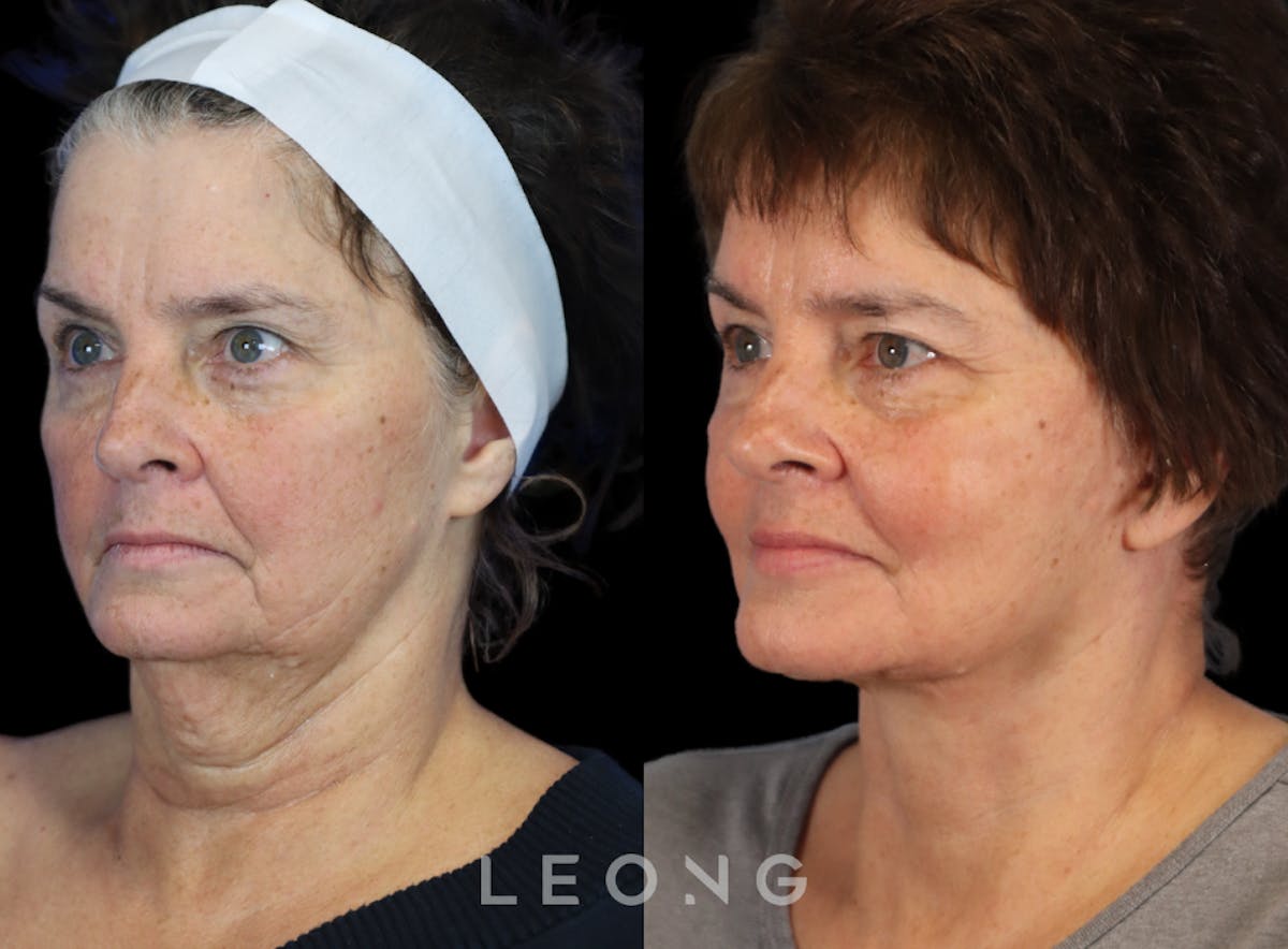 Facelift Before & After Gallery - Patient 231963 - Image 4