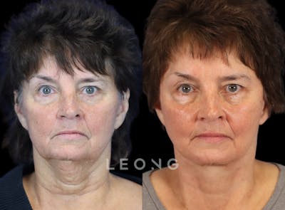 Facelift Before & After Gallery - Patient 231963 - Image 1