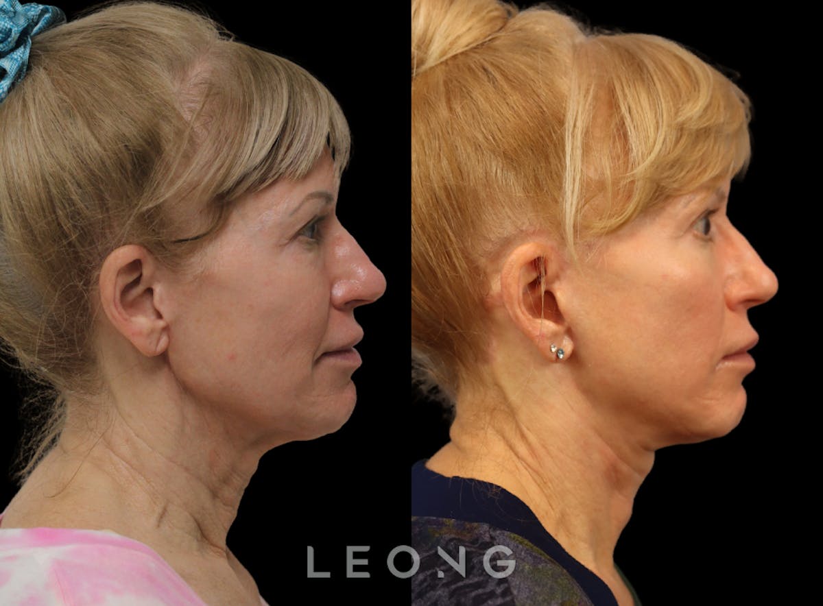 Facelift Before & After Gallery - Patient 254081 - Image 5
