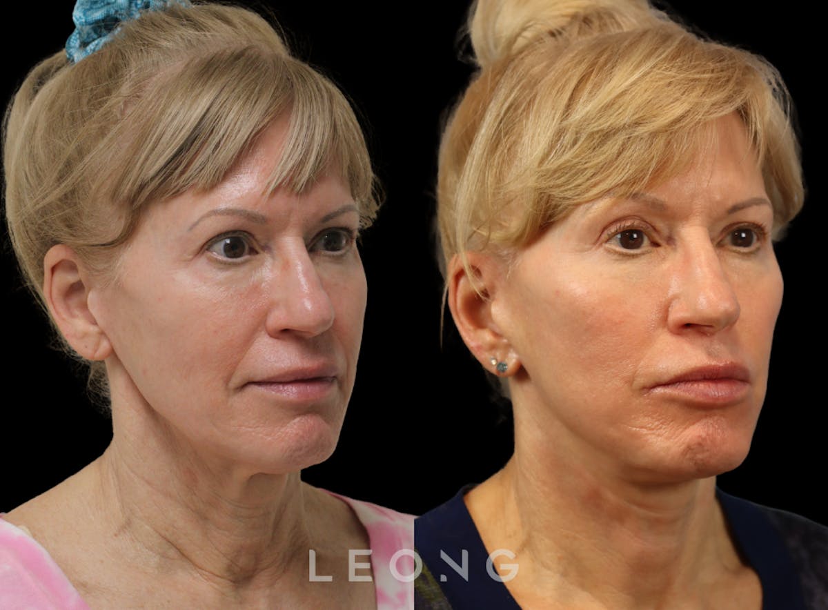 Facelift Before & After Gallery - Patient 254081 - Image 2