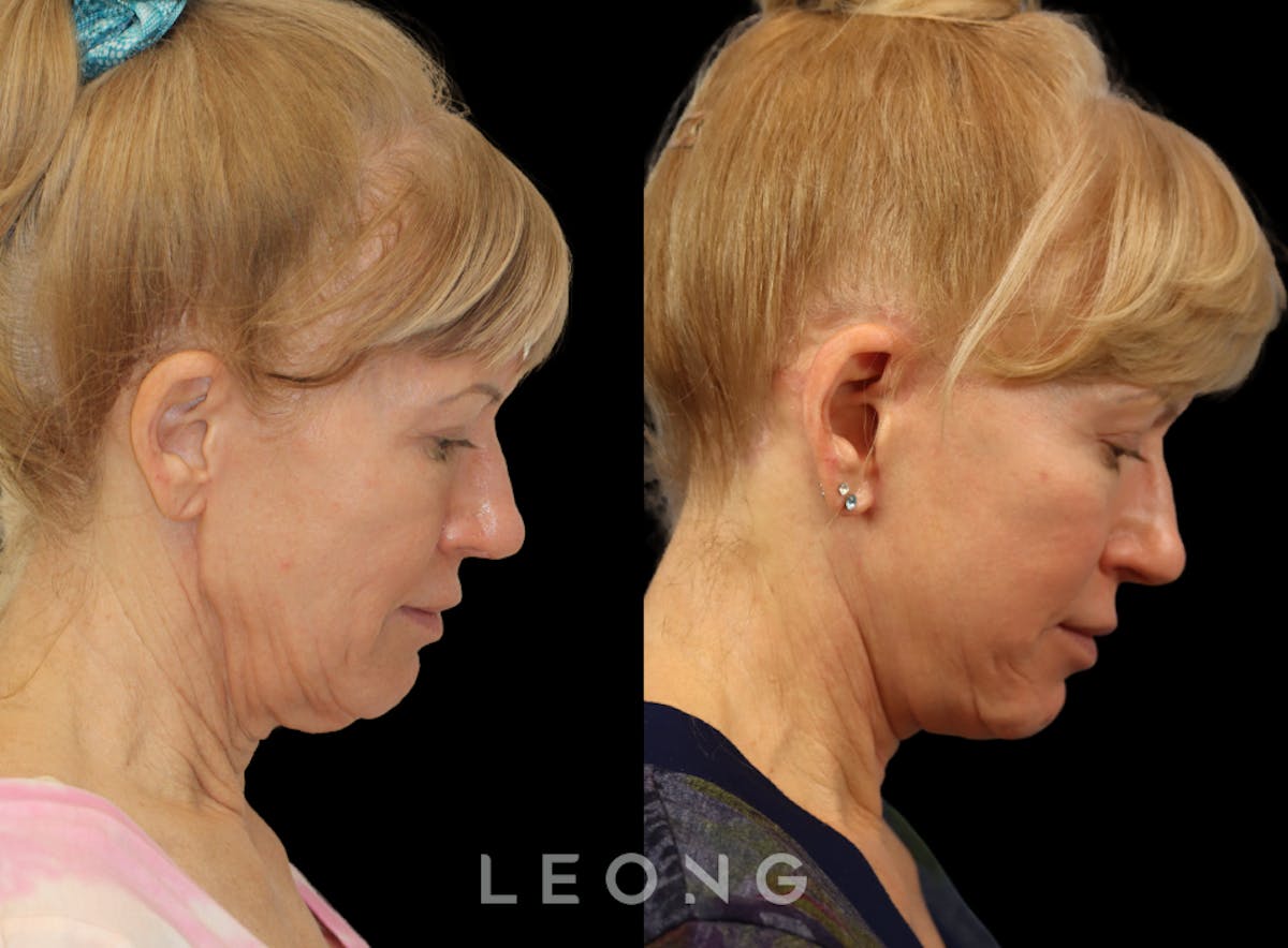 Facelift Before & After Gallery - Patient 254081 - Image 6