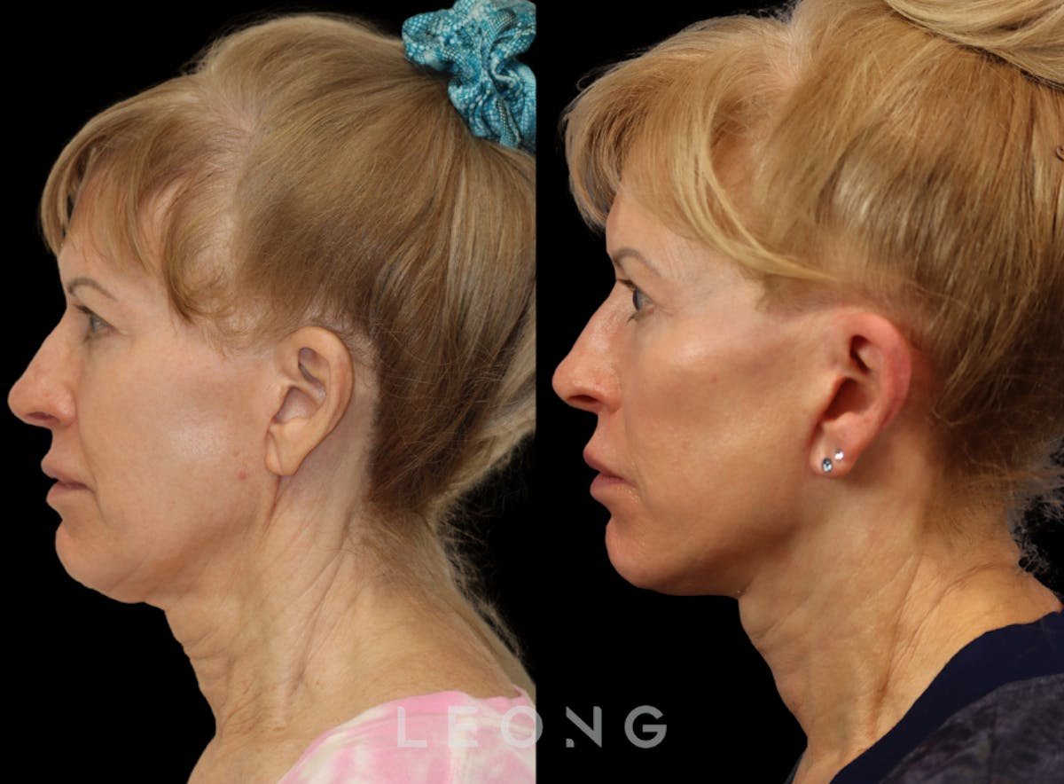 Facelift Before & After Gallery - Patient 254081 - Image 4