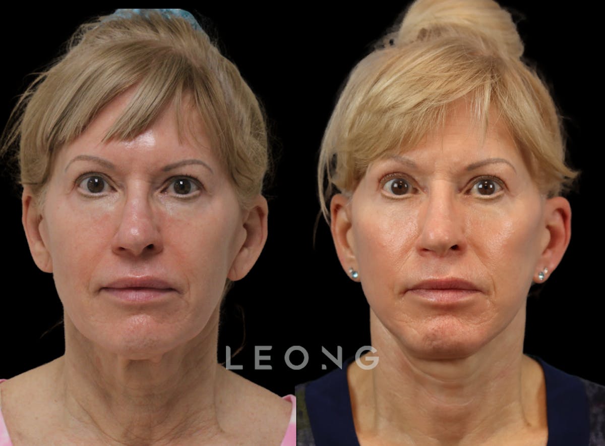 Facelift Before & After Gallery - Patient 254081 - Image 1