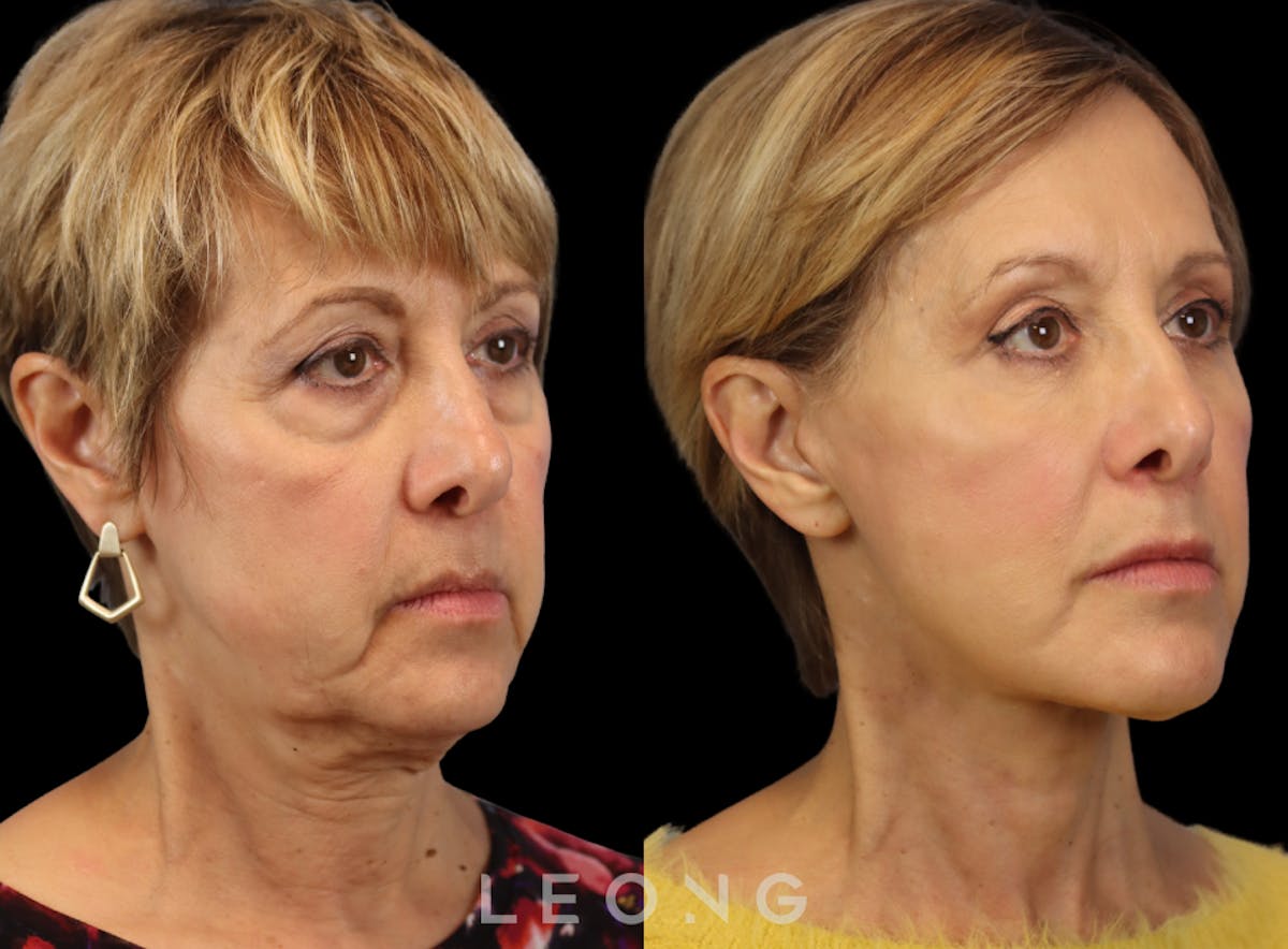 Facelift Before & After Gallery - Patient 371378 - Image 7