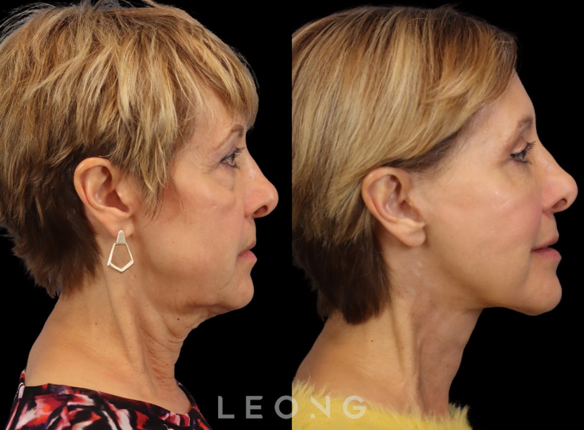 Facelift Before & After Gallery - Patient 371378 - Image 3