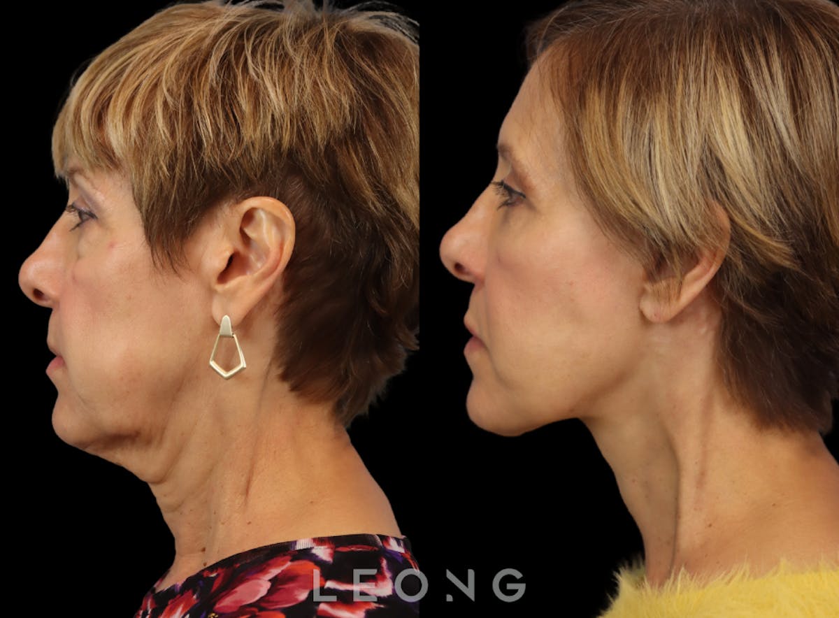 Facelift Before & After Gallery - Patient 371378 - Image 2