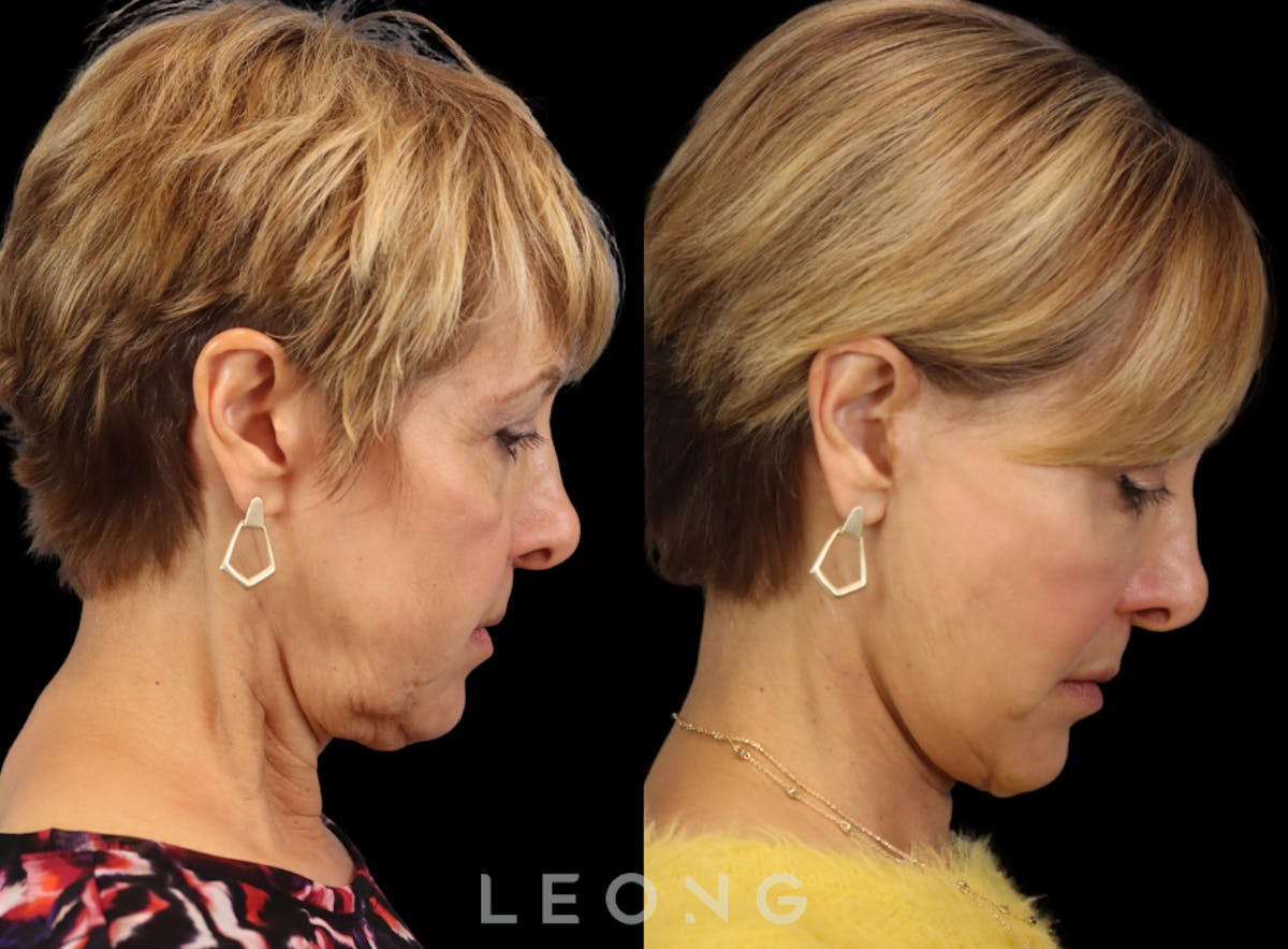 Facelift Before & After Gallery - Patient 371378 - Image 4