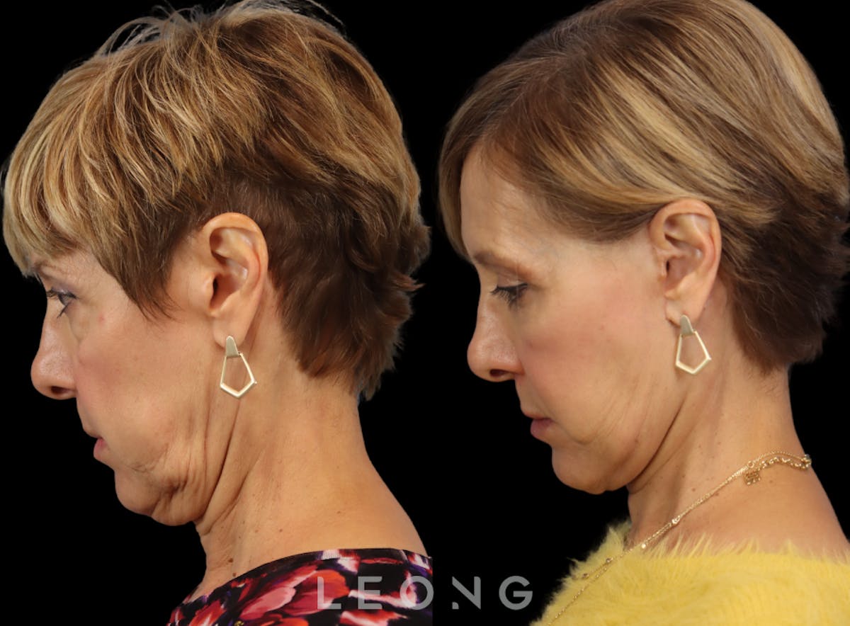 Facelift Before & After Gallery - Patient 371378 - Image 5