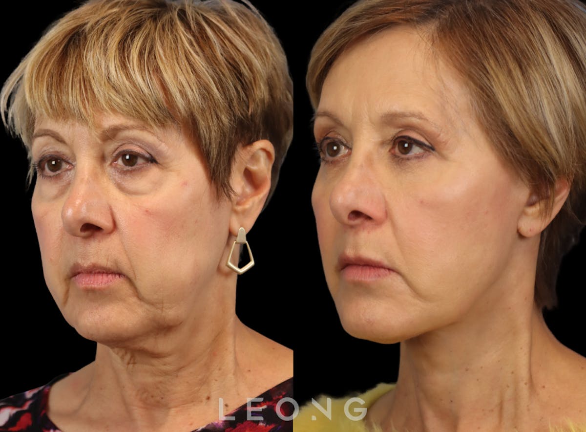 Facelift Before & After Gallery - Patient 371378 - Image 6