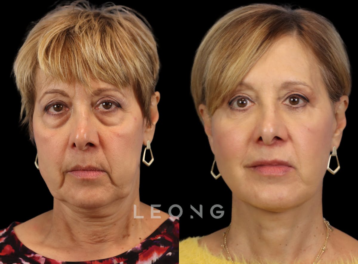 Facelift Before & After Gallery - Patient 371378 - Image 1