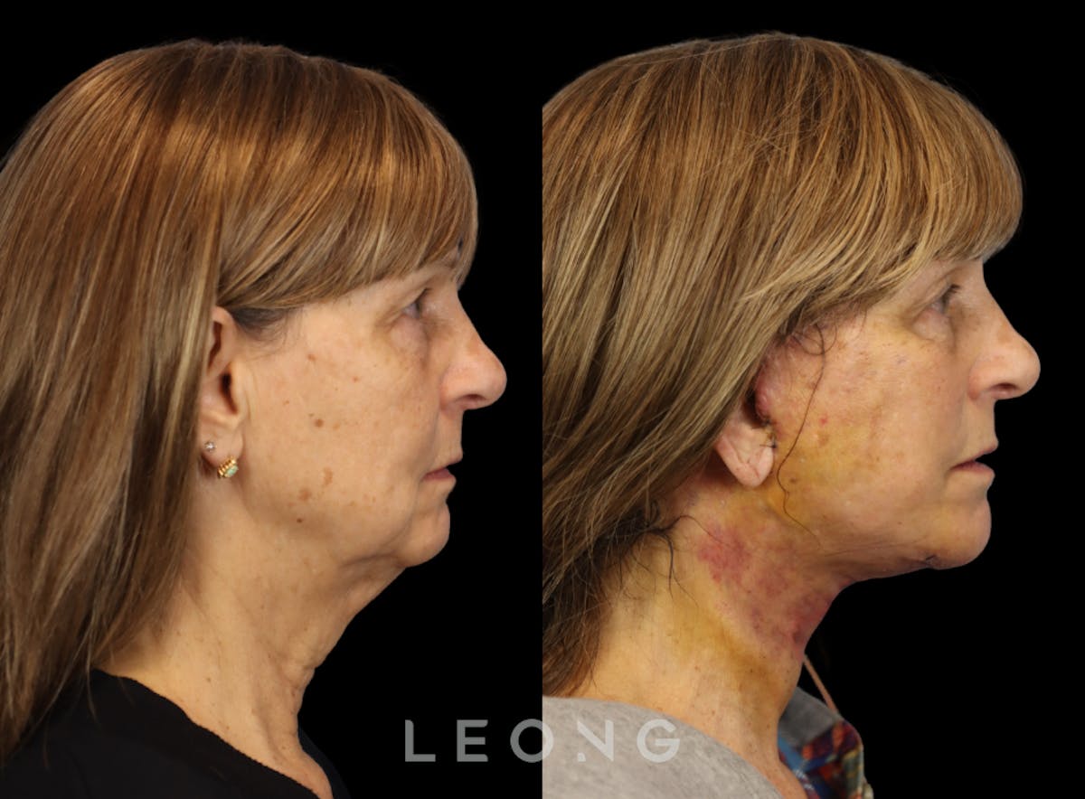 Facelift Before & After Gallery - Patient 153547 - Image 3