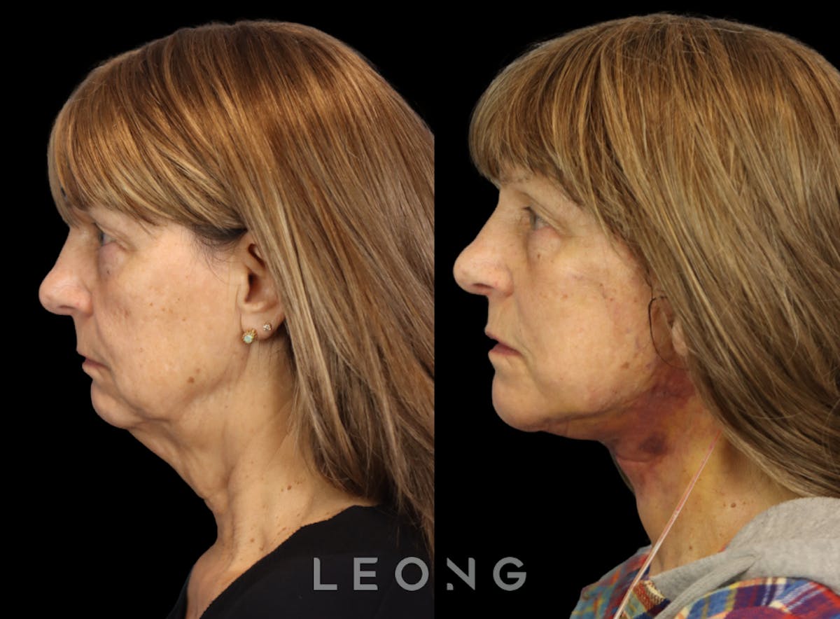 Facelift Before & After Gallery - Patient 153547 - Image 2