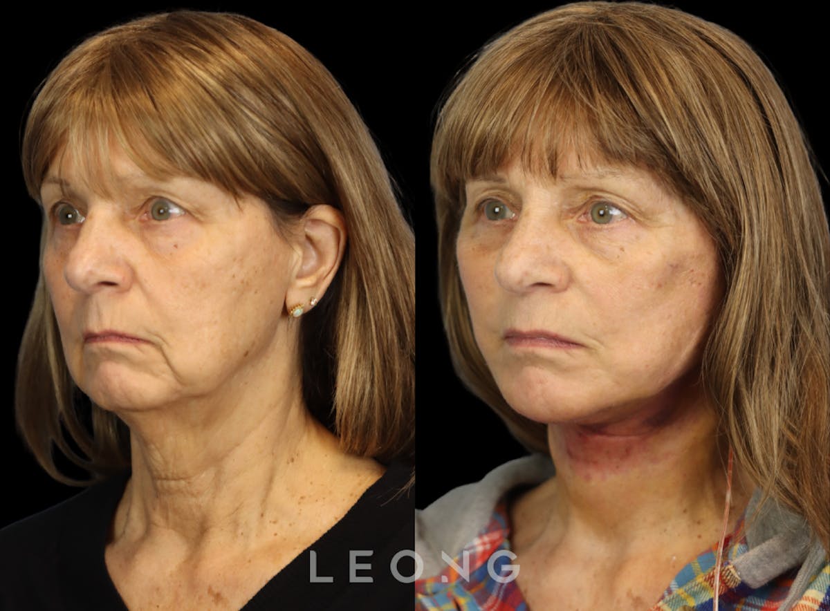 Facelift Before & After Gallery - Patient 153547 - Image 4