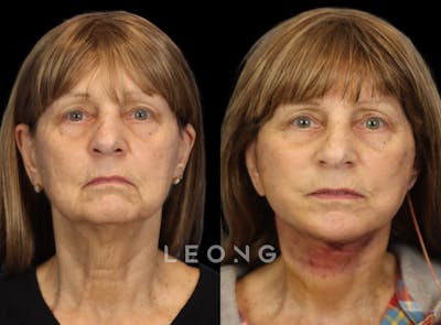 Facelift Before & After Gallery - Patient 153547 - Image 1