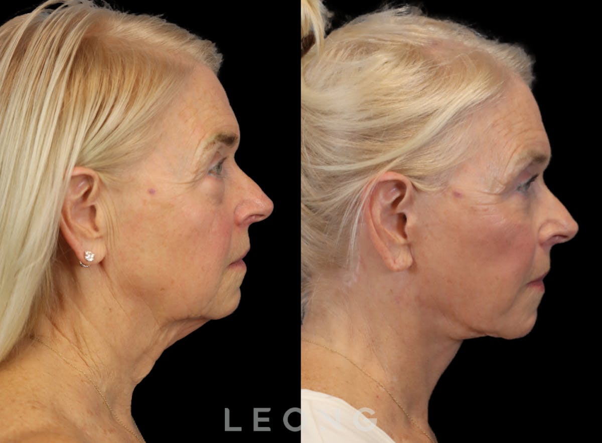 Facelift Before & After Gallery - Patient 175334 - Image 4