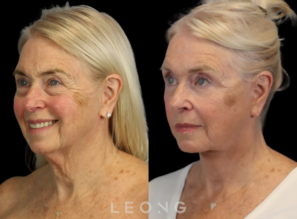 Facelift Before & After Gallery - Patient 175334 - Image 2