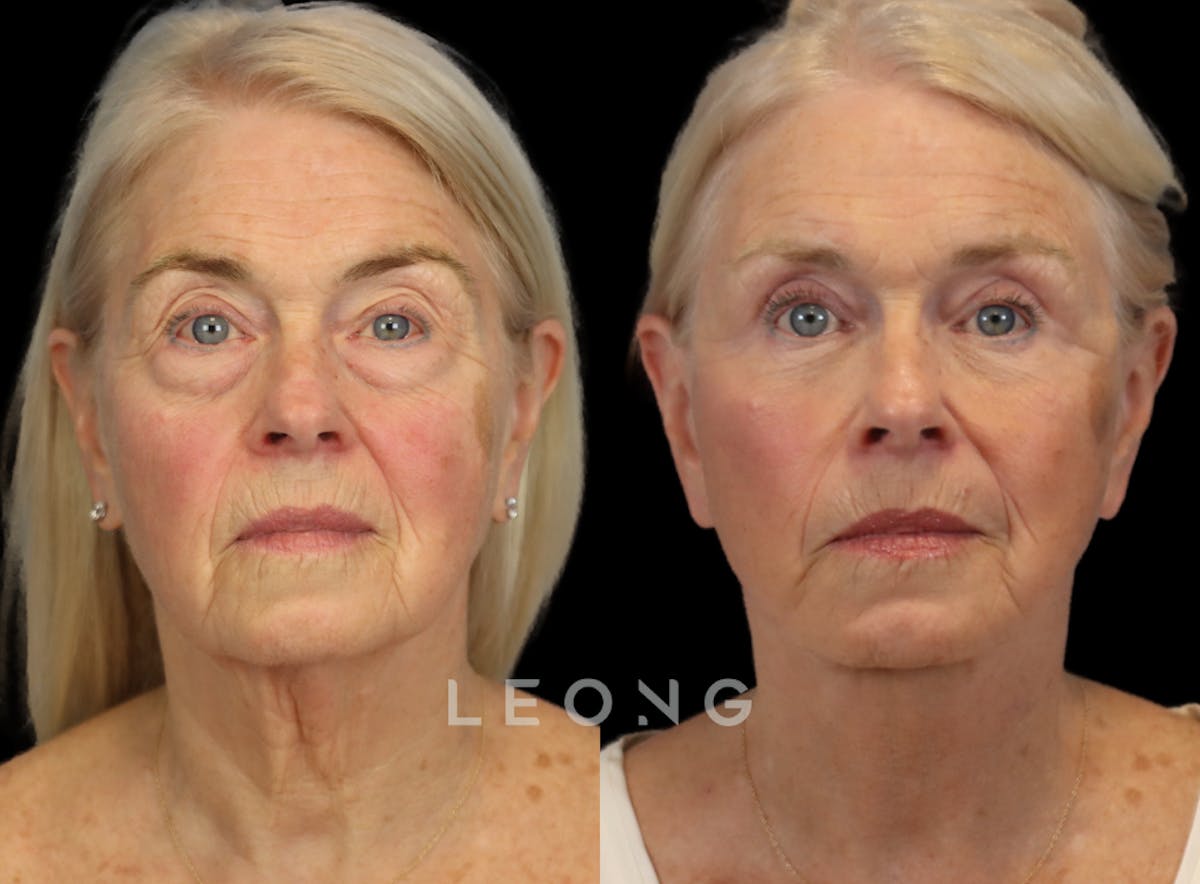 Facelift Before & After Gallery - Patient 175334 - Image 1