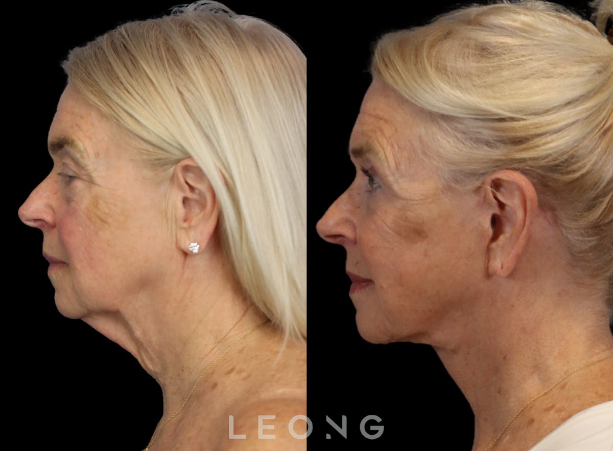 Facelift Before & After Gallery - Patient 175334 - Image 5
