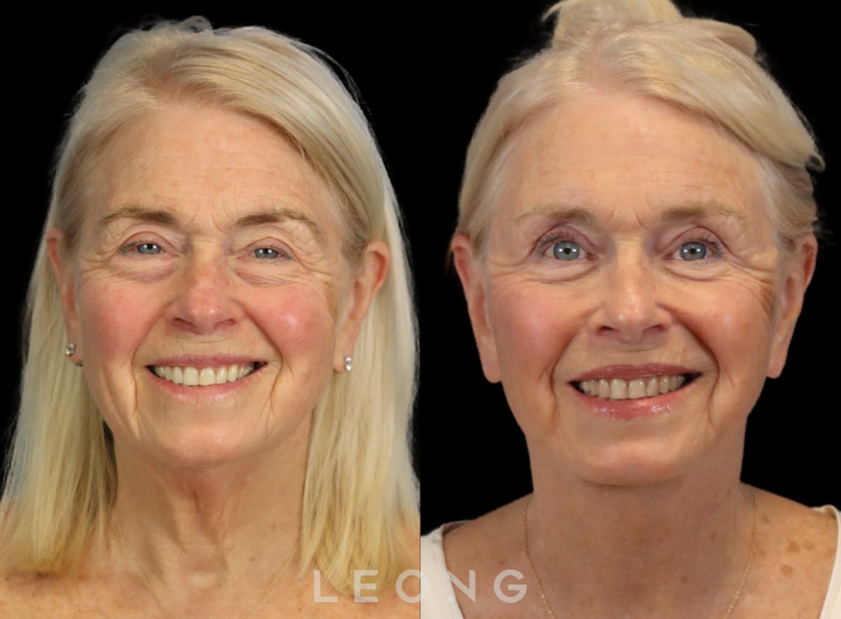 Facelift Before & After Gallery - Patient 175334 - Image 6