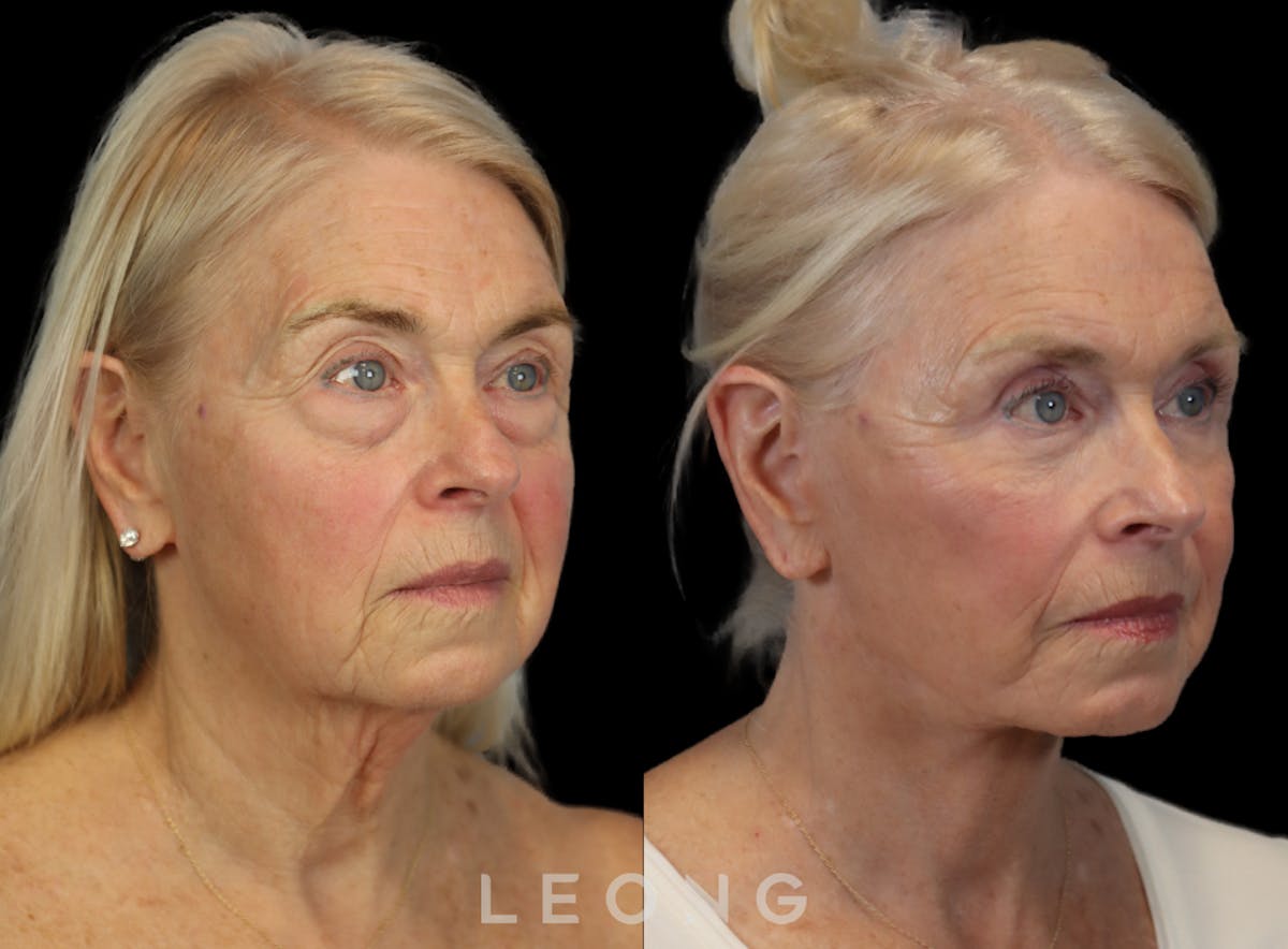 Facelift Before & After Gallery - Patient 175334 - Image 3