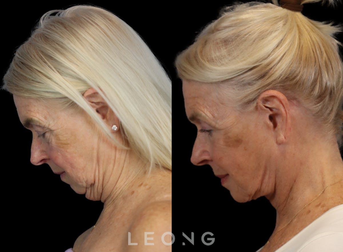 Facelift Before & After Gallery - Patient 175334 - Image 7