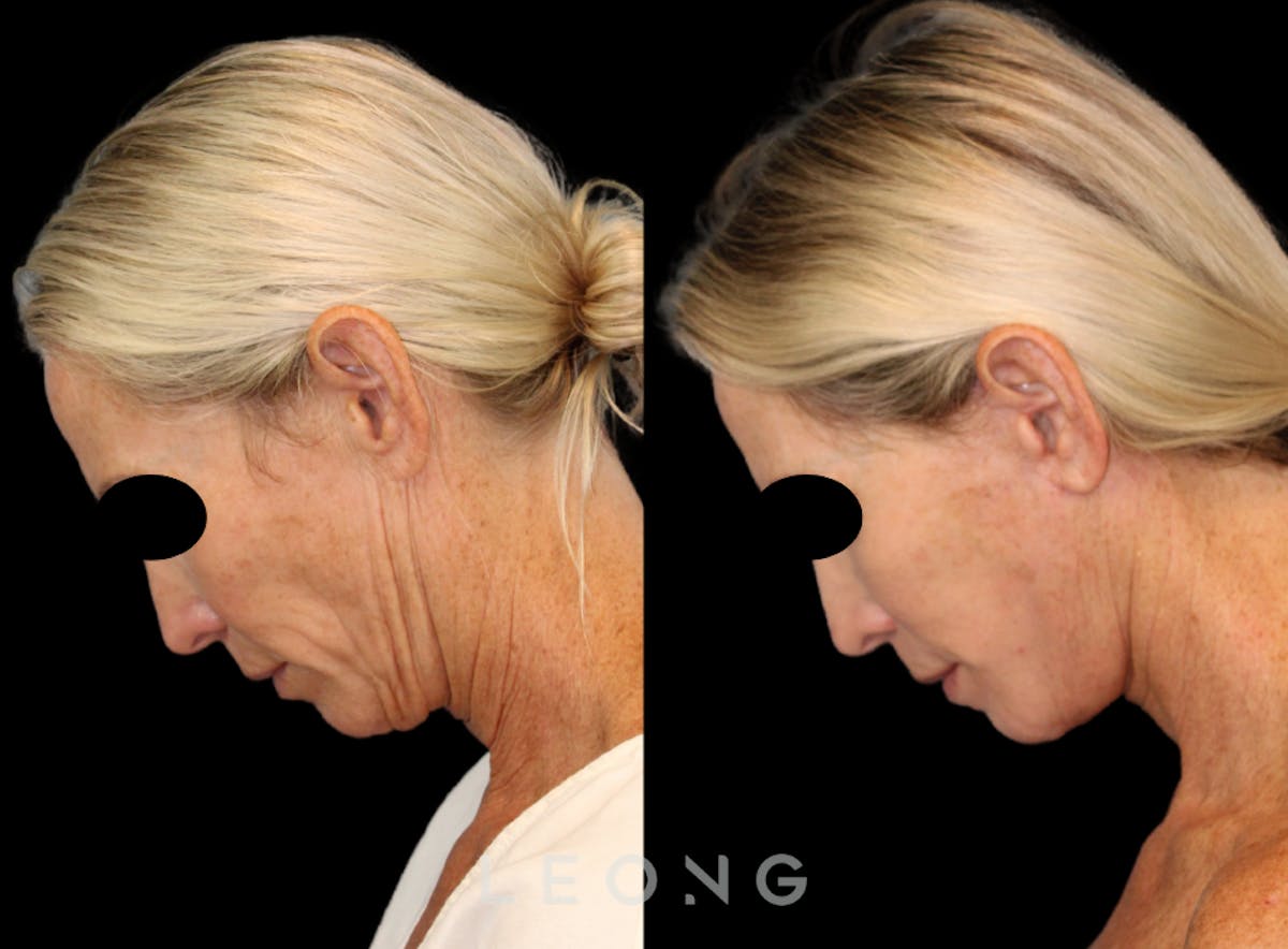 Facelift Before & After Gallery - Patient 813448 - Image 2