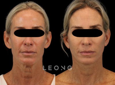 Facelift Before & After Gallery - Patient 813448 - Image 1