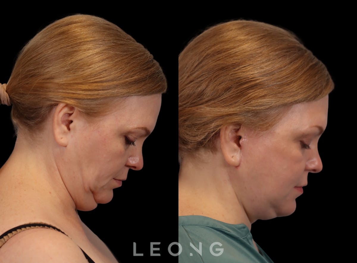Facelift Before & After Gallery - Patient 512599 - Image 7
