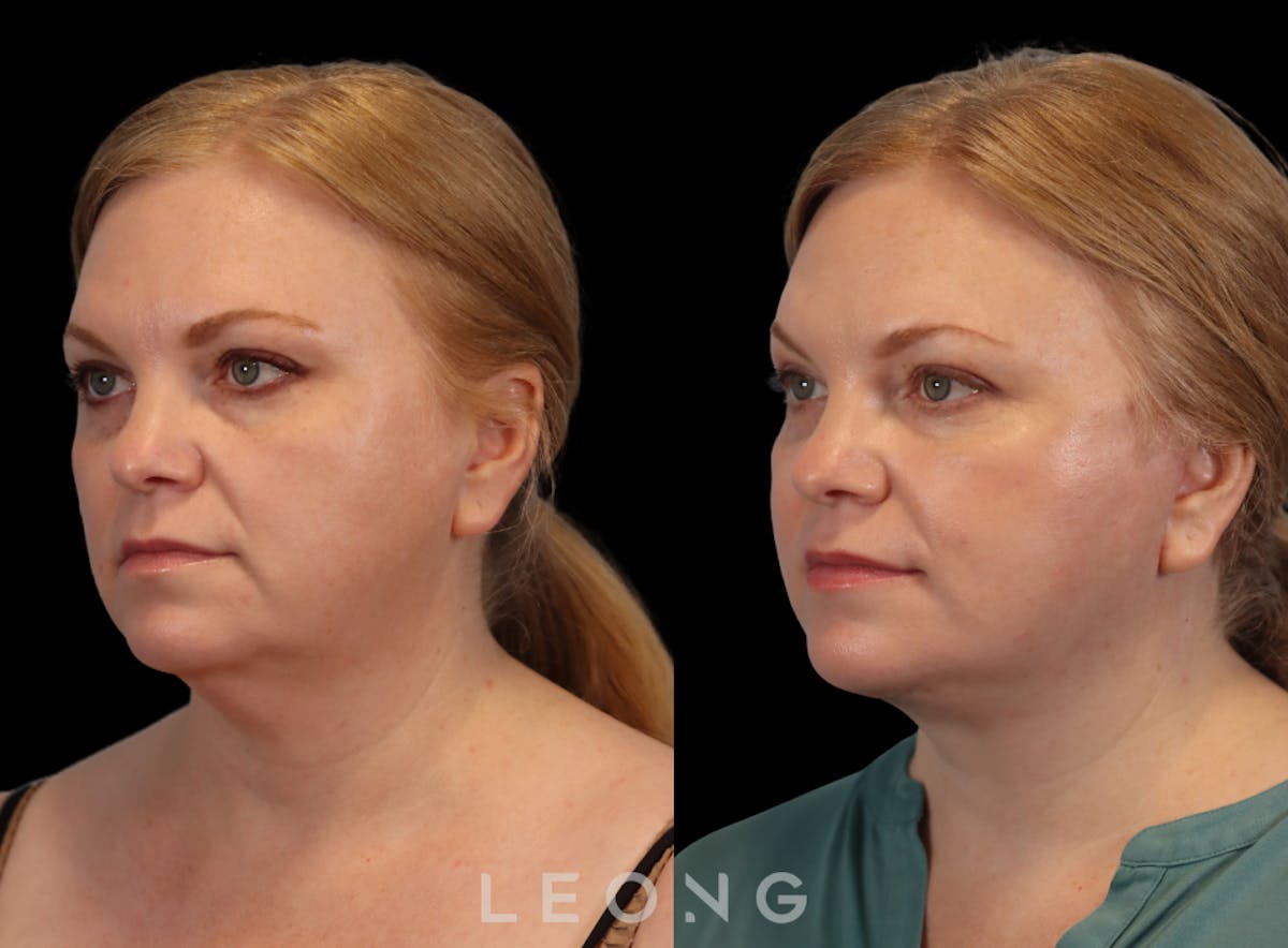 Facelift Before & After Gallery - Patient 512599 - Image 4