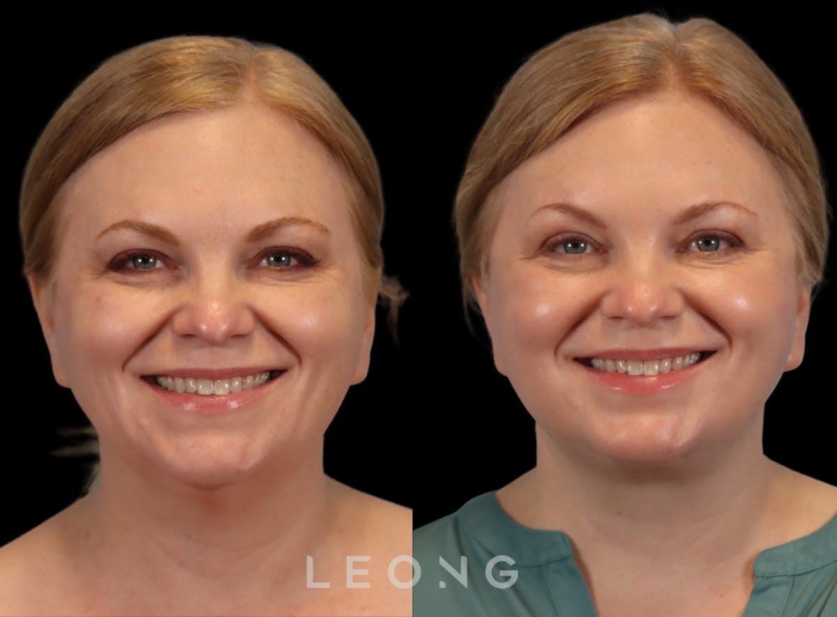 Facelift Before & After Gallery - Patient 512599 - Image 8