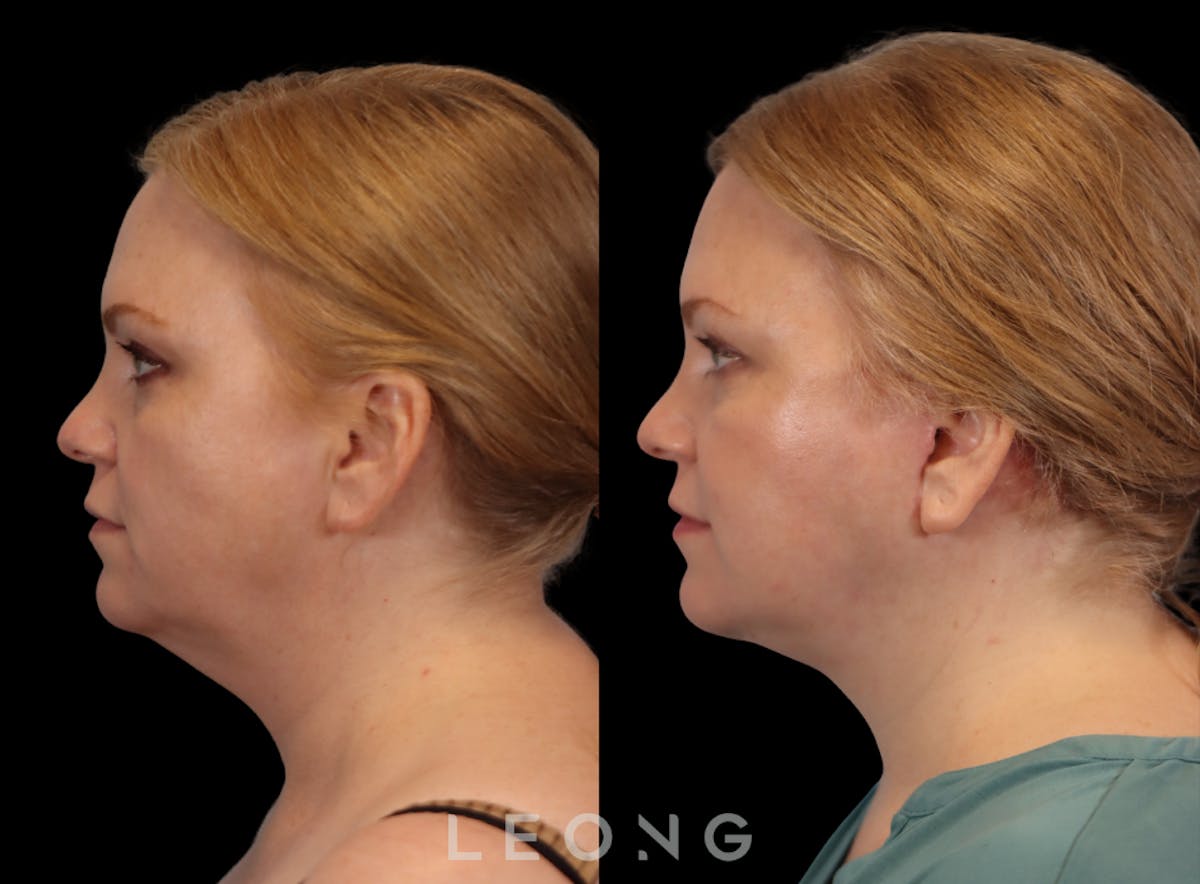 Facelift Before & After Gallery - Patient 512599 - Image 2