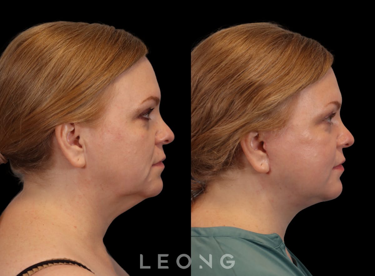 Facelift Before & After Gallery - Patient 512599 - Image 3