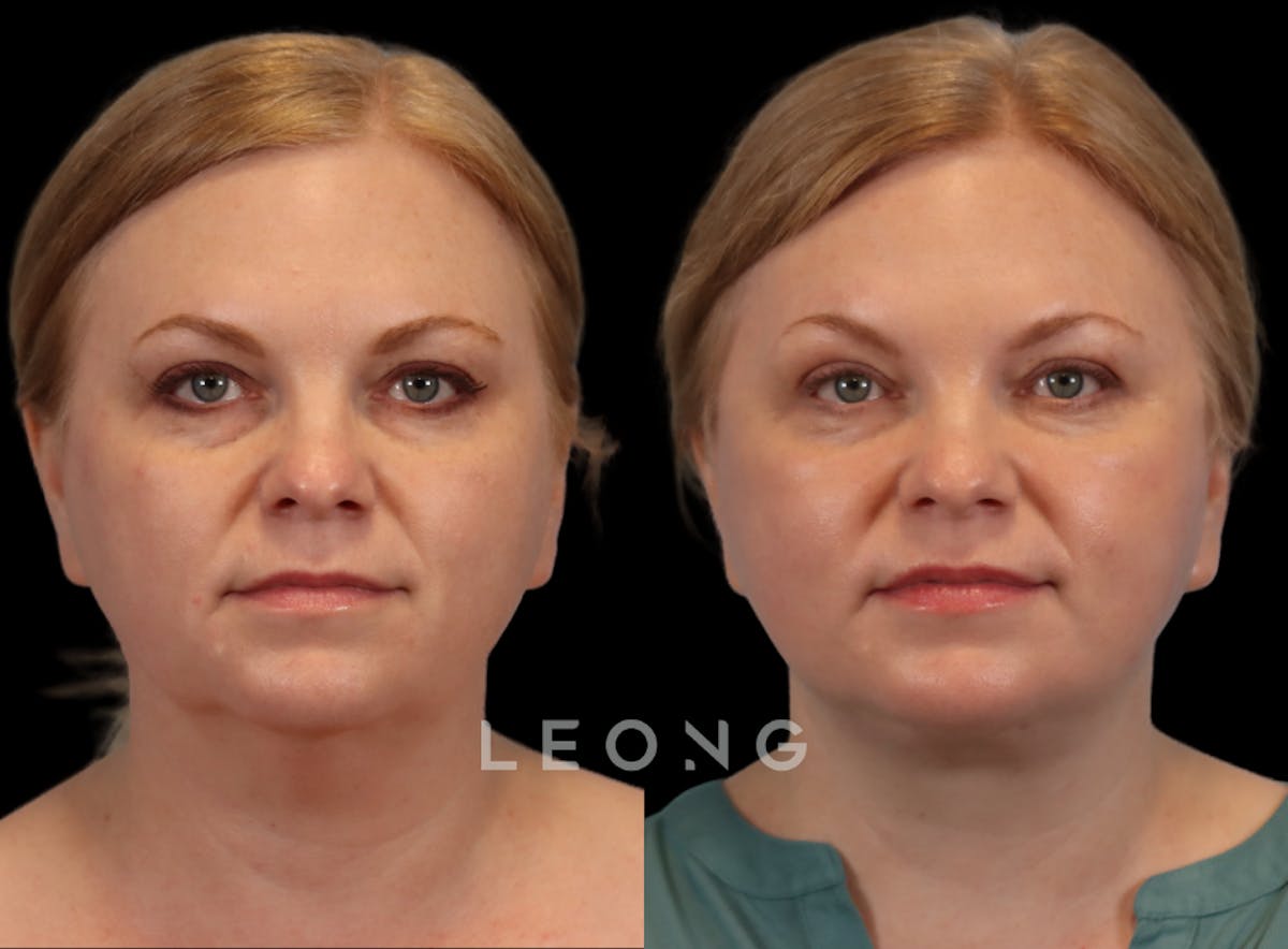 Facelift Before & After Gallery - Patient 512599 - Image 1