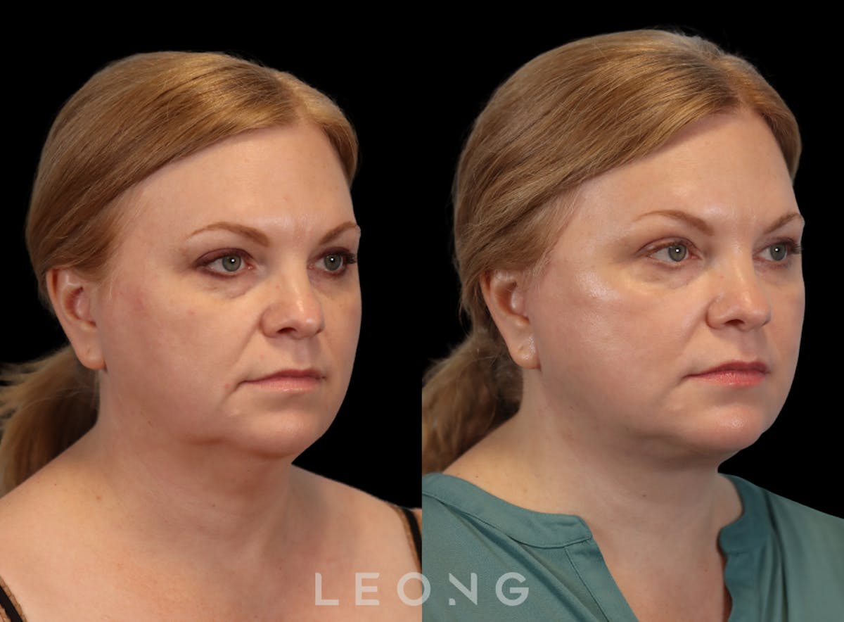 Facelift Before & After Gallery - Patient 512599 - Image 5