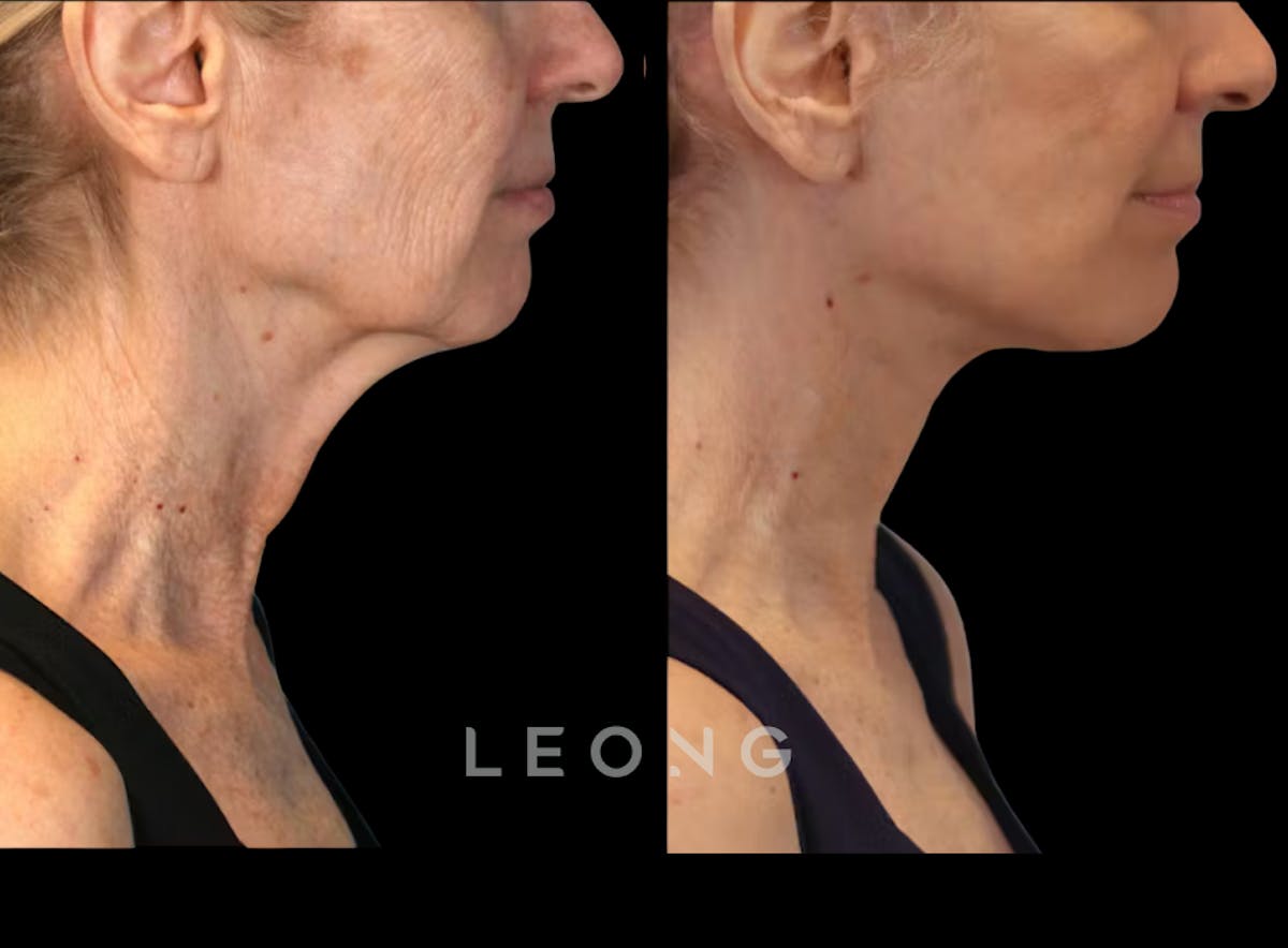 Facelift Before & After Gallery - Patient 238132 - Image 1