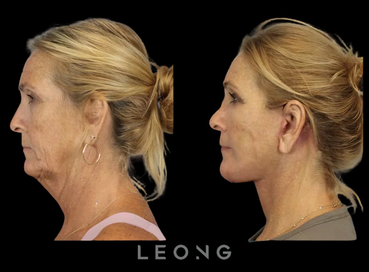 Facelift Before & After Gallery - Patient 279946 - Image 2