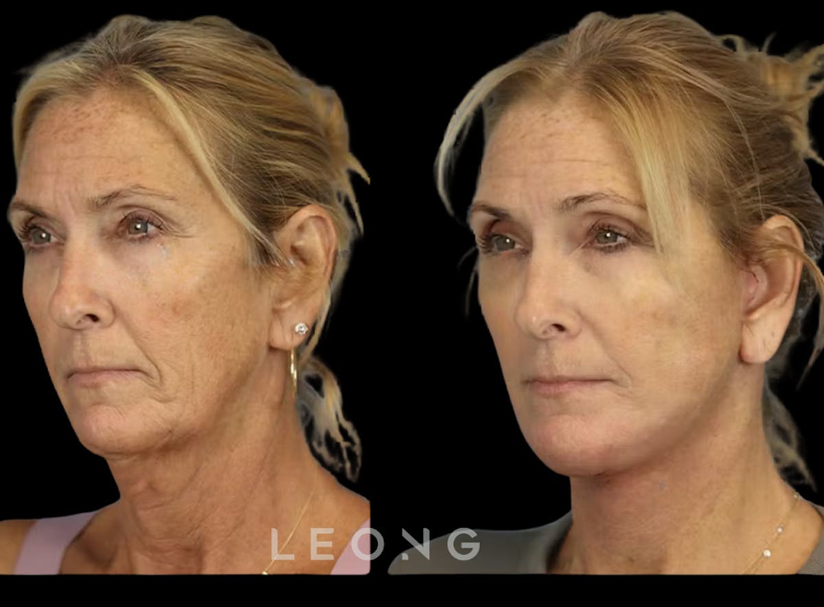 Facelift Before & After Gallery - Patient 279946 - Image 3
