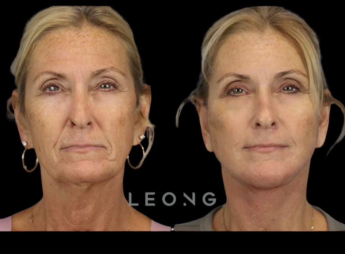 Facelift Before & After Gallery - Patient 279946 - Image 1