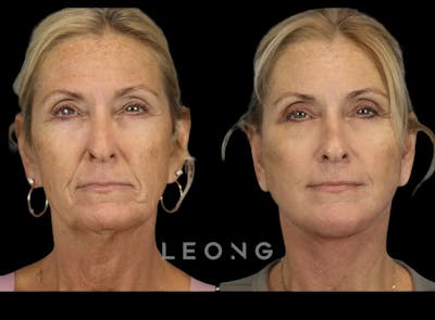 Facelift Before & After Gallery - Patient 279946 - Image 1