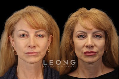 Eyes Before & After Gallery - Patient 389548 - Image 1