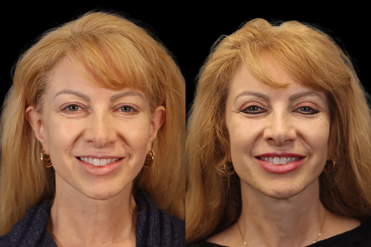 Blepharoplasty Before & After Gallery - Patient 964435 - Image 2