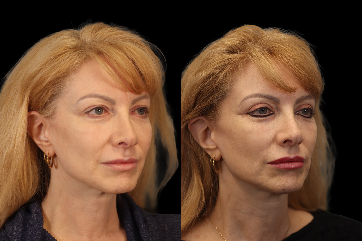Blepharoplasty Before & After Gallery - Patient 964435 - Image 3