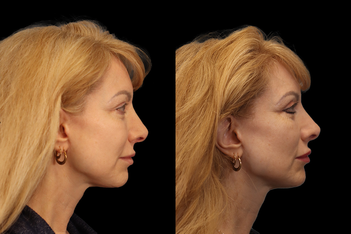 Blepharoplasty Before & After Gallery - Patient 964435 - Image 4